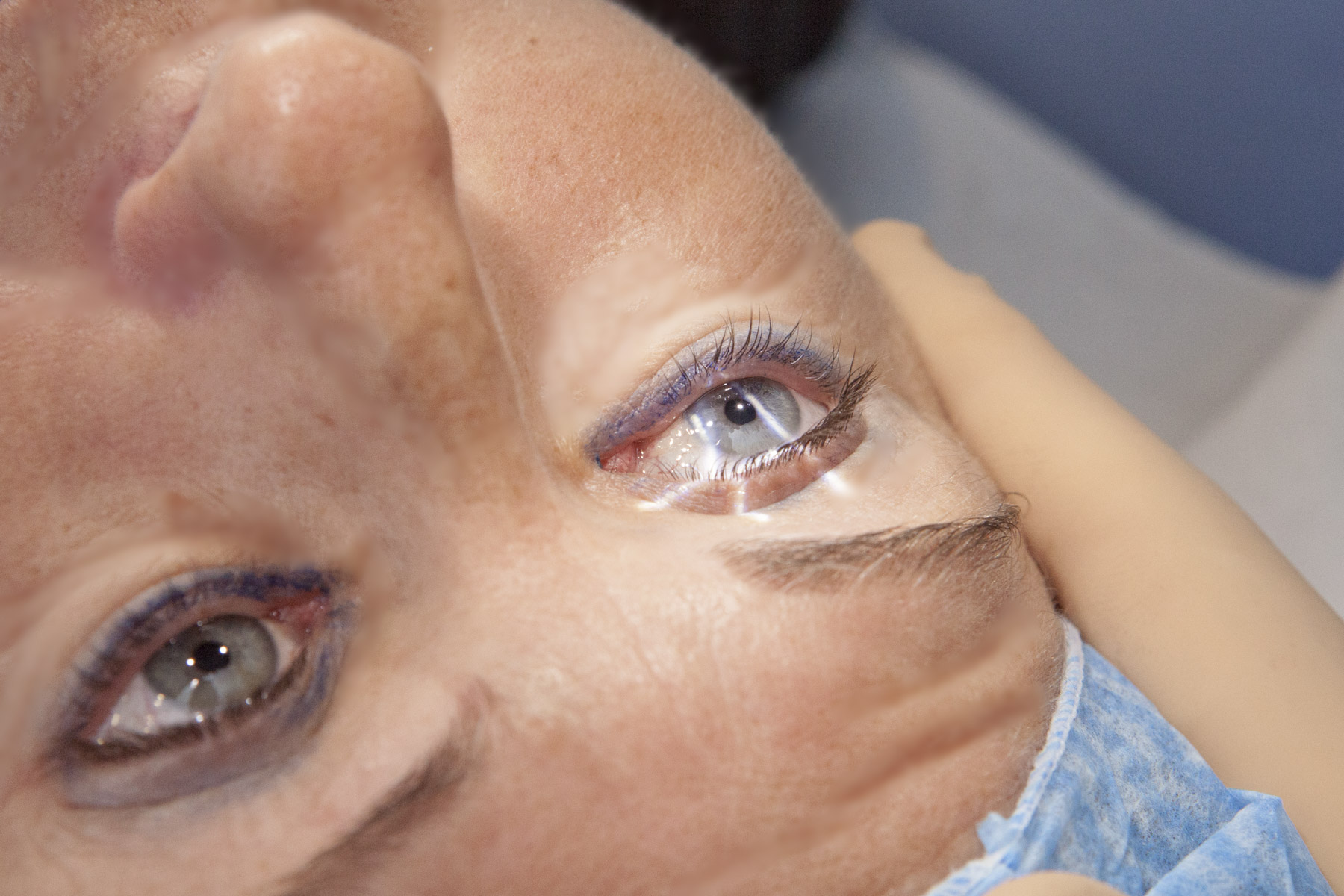 Laufende ophthalmologische Laserbehandlung