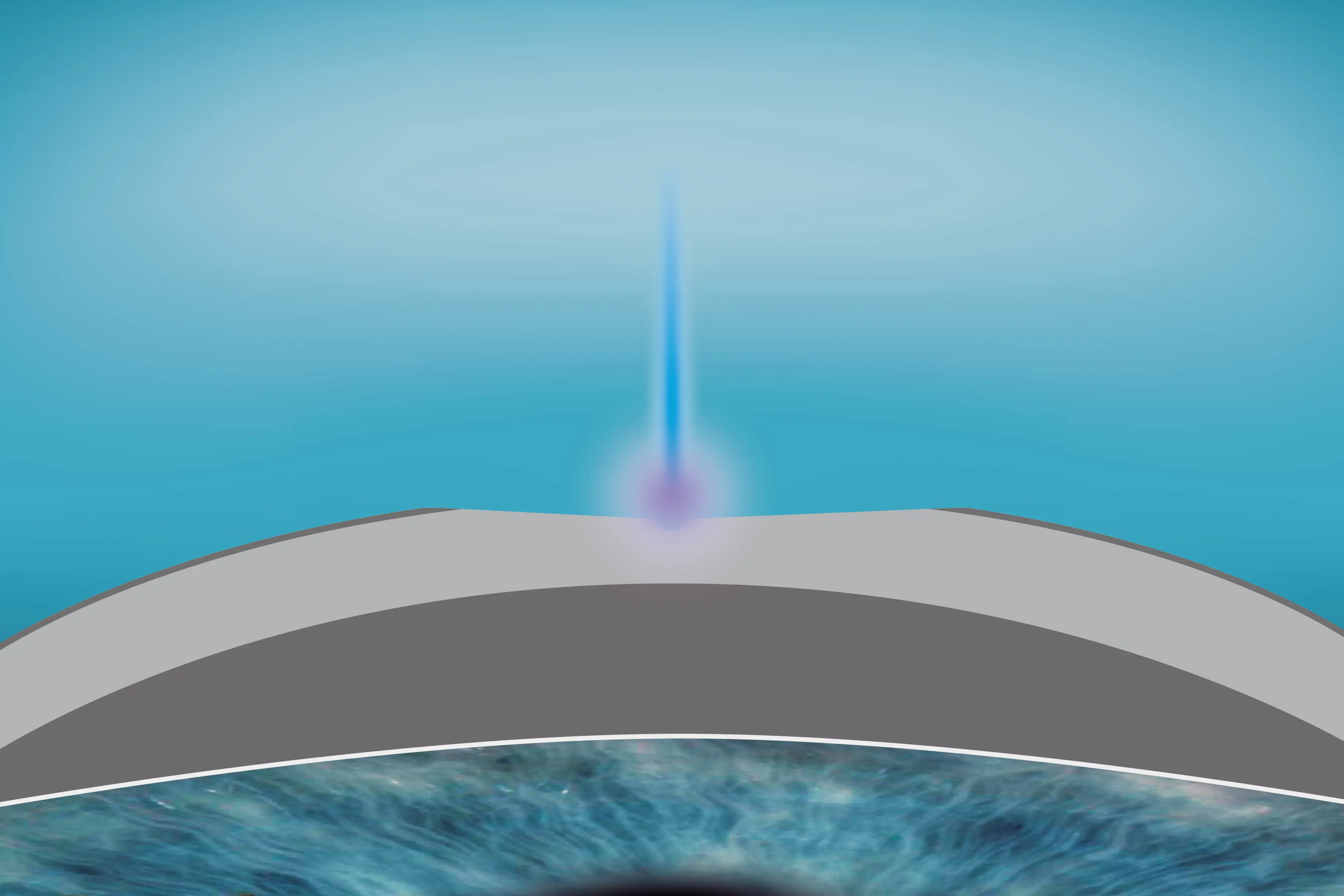 Illustration der epithelialen Komponenten-Ablation im SmartSurfACE-Verfahren