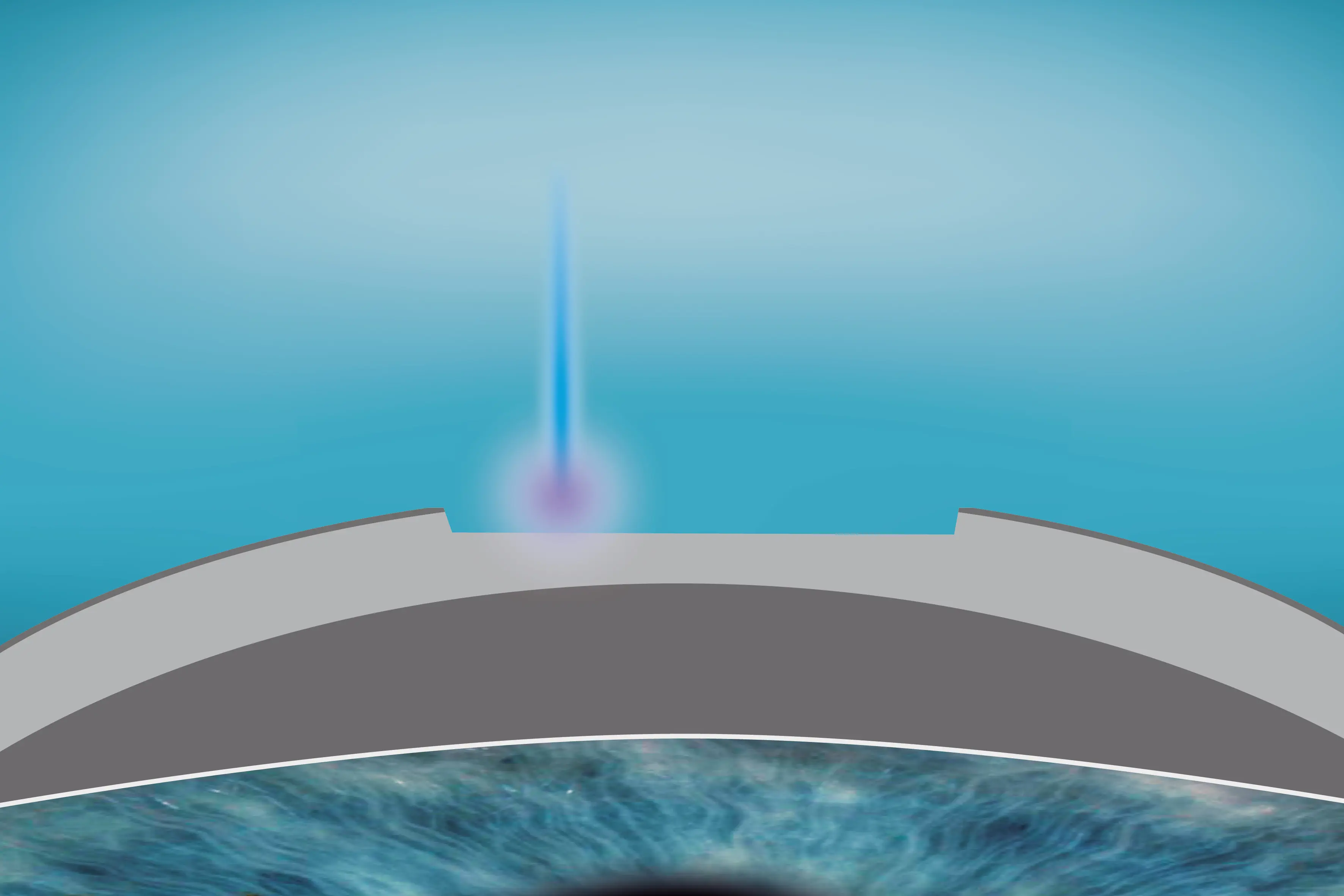 Illustration der refraktiven Komponenten-Ablation im SmartSurfACE-Verfahren